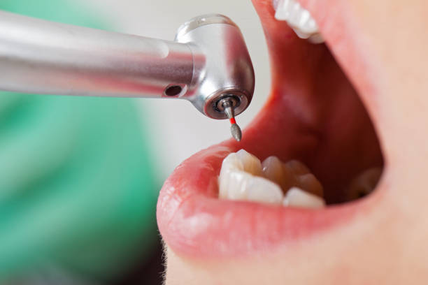 Best Urgent Care for Lost Fillings or Crowns in Newton, NJ
